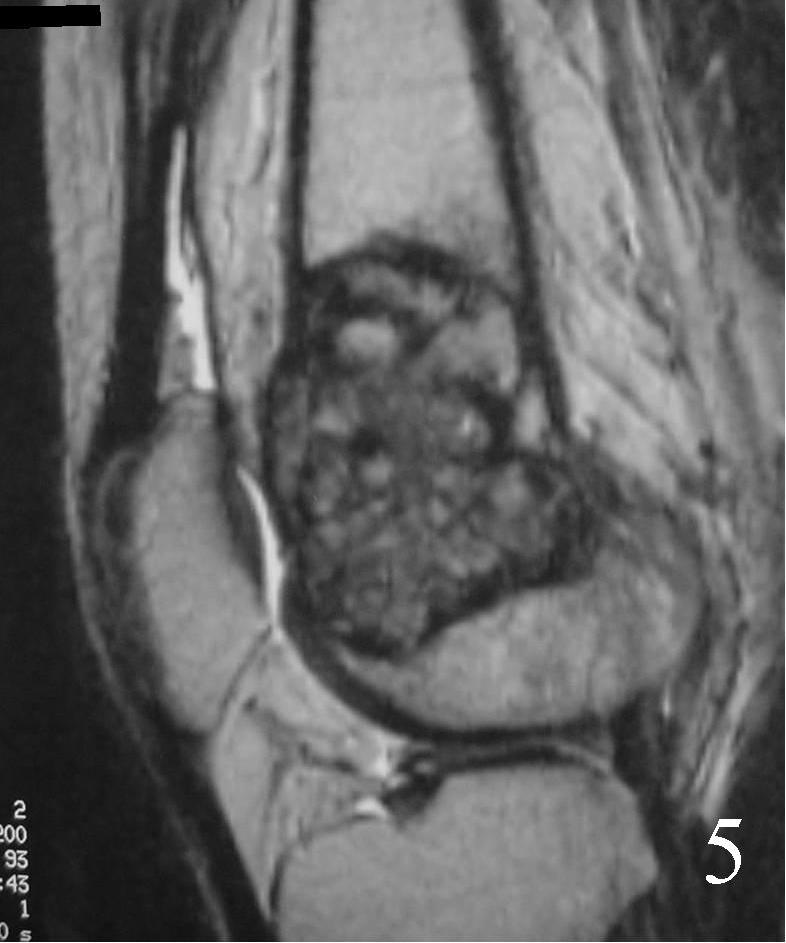 Giant Cell Tumor Of Bone: Bone Tumors